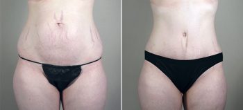 Breast Enlargement (Augmentation) Patient 63