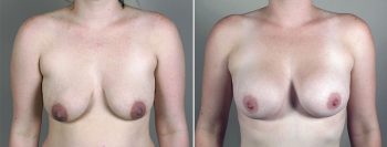 Breast Enlargement (Augmentation) Patient 63
