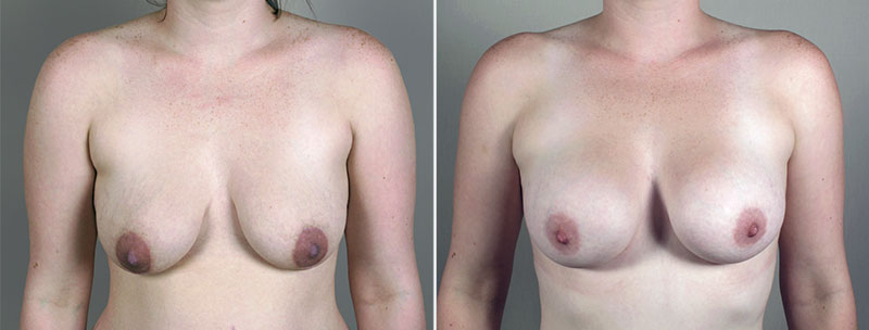 Breast Enlargement (Augmentation) Patient 63