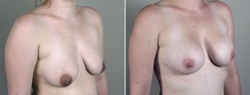 Breast Enlargement (Augmentation) Patient 63