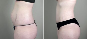 Breast Enlargement (Augmentation) Patient 63