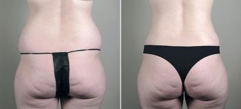 Breast Enlargement (Augmentation) Patient 63