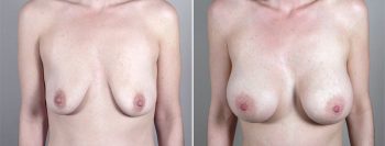 Breast Enlargement (Augmentation) Patient 64