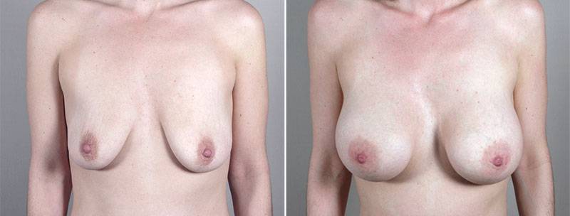 Breast Enlargement (Augmentation) Patient 64