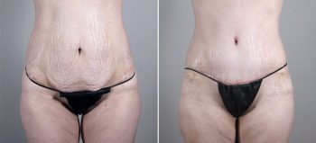 Breast Enlargement (Augmentation) Patient 64