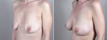Breast Enlargement (Augmentation) Patient 64