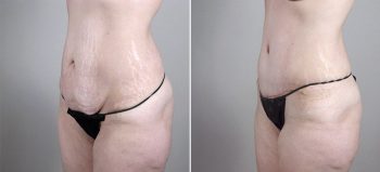 Breast Enlargement (Augmentation) Patient 64