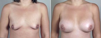 Breast Enlargement (Augmentation) Patient 65