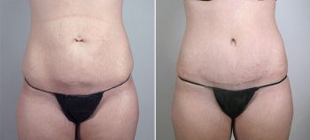 Breast Enlargement (Augmentation) Patient 65