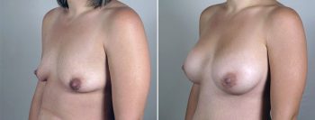 Breast Enlargement (Augmentation) Patient 65