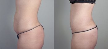 Breast Enlargement (Augmentation) Patient 65