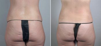 Breast Enlargement (Augmentation) Patient 65