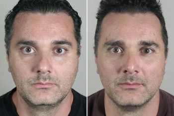 Male Rhinoplasty Patient 16