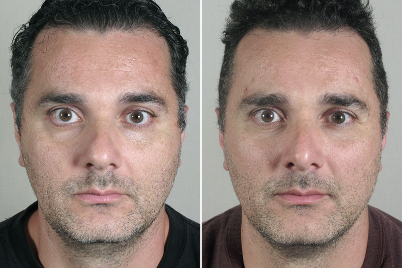 Male Rhinoplasty Patient 16