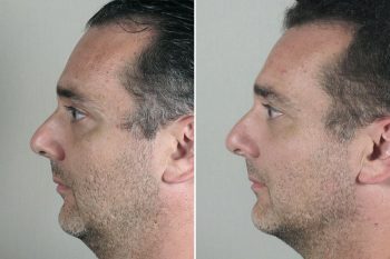 Male Rhinoplasty Patient 16