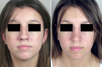 Rhinoplasty Patient 46