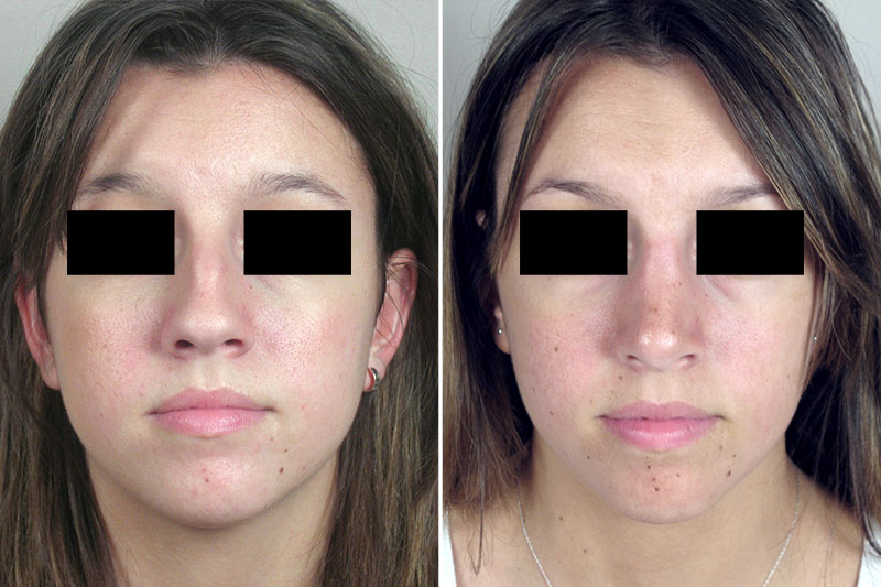 Rhinoplasty Patient 46