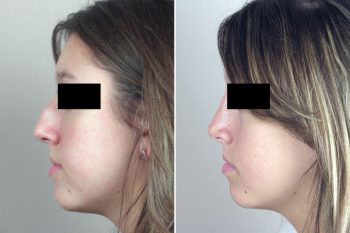 Rhinoplasty Patient 46