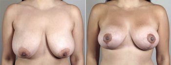 Breast Lift with Auto-Augmentation Patient 3