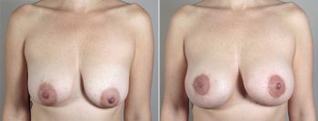 Breast Lift with Implants Patient 28