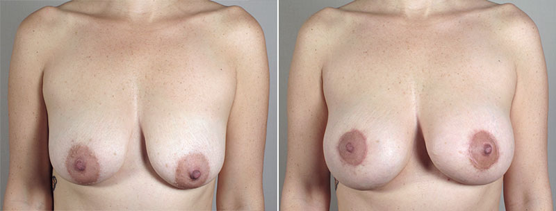 Breast Lift with Implants Patient 28
