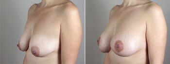 Breast Lift with Implants Patient 28