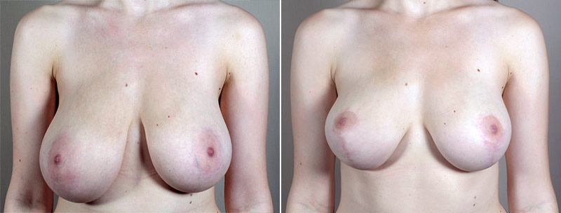 Breast Lift (Vertical Mastopexy Only) Patient 13