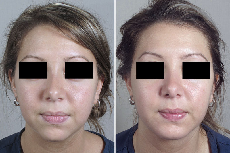 Chin Implant Patient 17