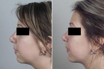 Chin Implant Patient 17