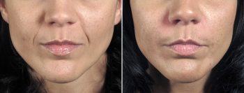 Angela’s Patient 10 – Restylane