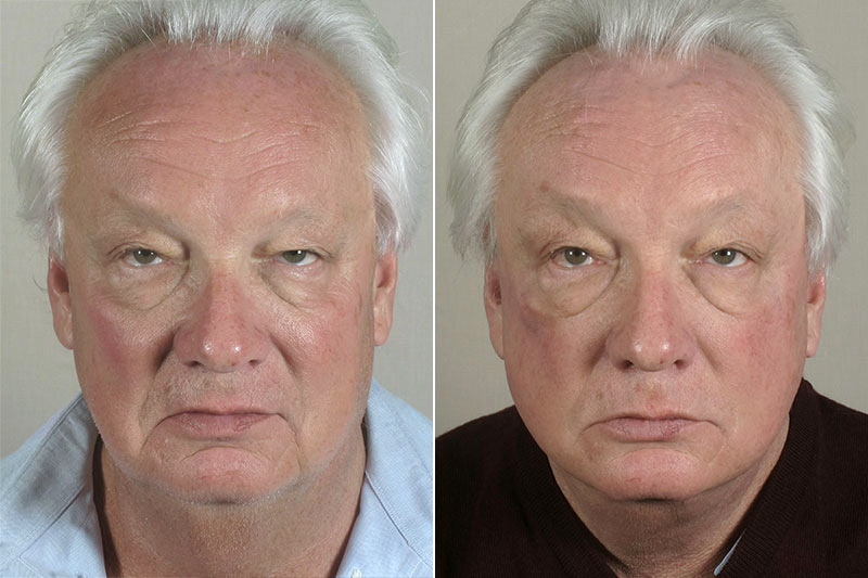 Male Facelift Patient 6