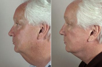 Male Facelift Patient 6