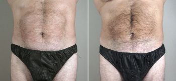 Male Liposuction Patient 21