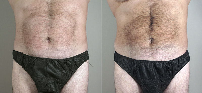 Male Liposuction Patient 21