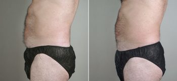 Male Liposuction Patient 21