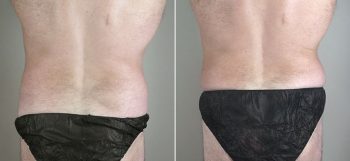 Male Liposuction Patient 21