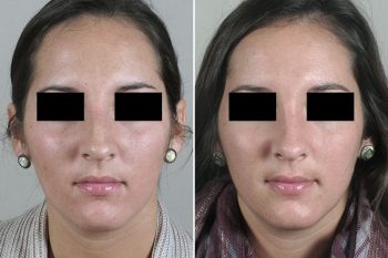Rhinoplasty Patient 47