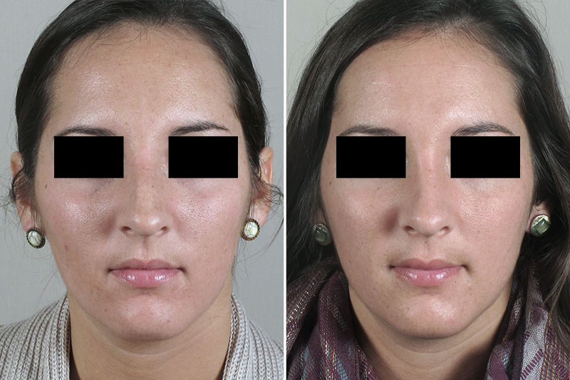 Rhinoplasty Patient 47
