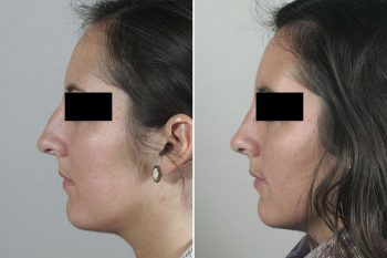 Rhinoplasty Patient 47
