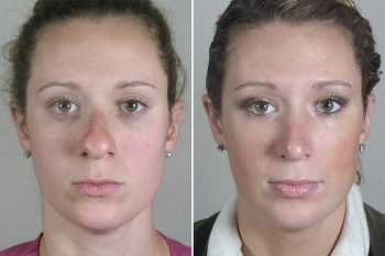 Rhinoplasty Patient 48