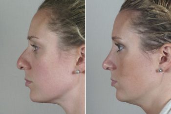 Rhinoplasty Patient 48