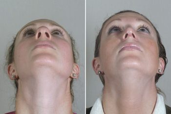 Rhinoplasty Patient 48