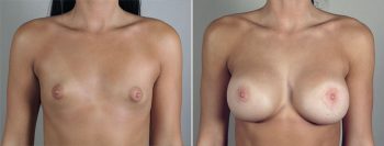 Breast Lift with Implants Patient 30