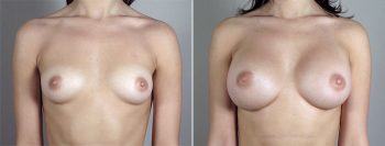 Breast Enlargement (Augmentation) Patient 67