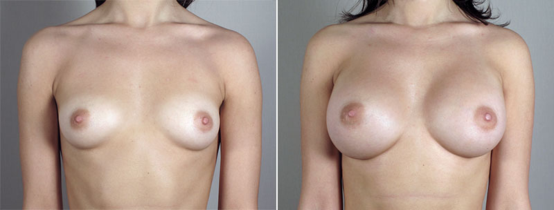 Breast Enlargement (Augmentation) Patient 67