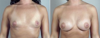 Breast Enlargement (Augmentation) Patient 68