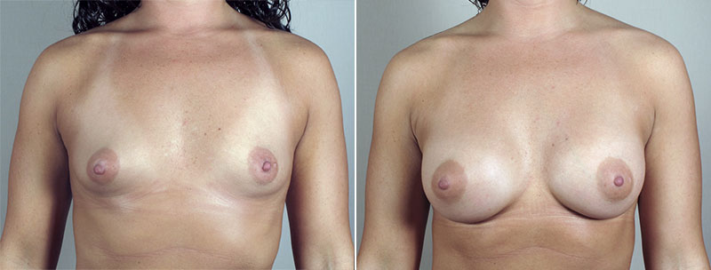 Breast Enlargement (Augmentation) Patient 68