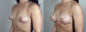 Breast Enlargement (Augmentation) Patient 68