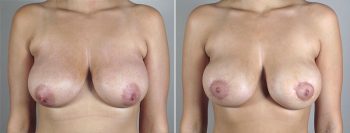 Breast Lift with Implants Patient 29