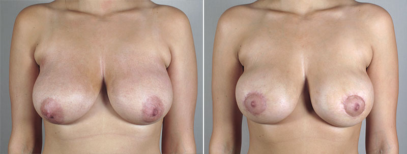 Breast Lift with Implants Patient 29